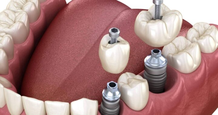 Los implantes de carga inmediata que ofrece Implant Clinics