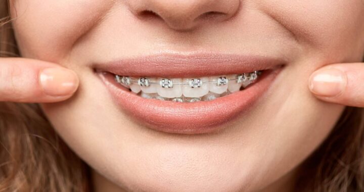Clínica DeltaDent, las ventajas de los tratamientos de ortodoncia convencional y ortodoncia invisible