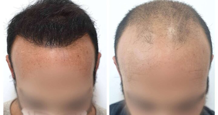Combatir la alopecia androgénica de la mano de Injermur