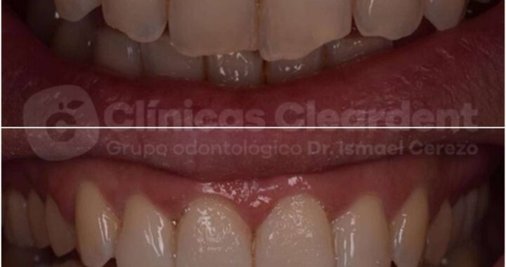 ¿Cuál es la función de las carillas dentales? Las opciones que ofrece Cleardent